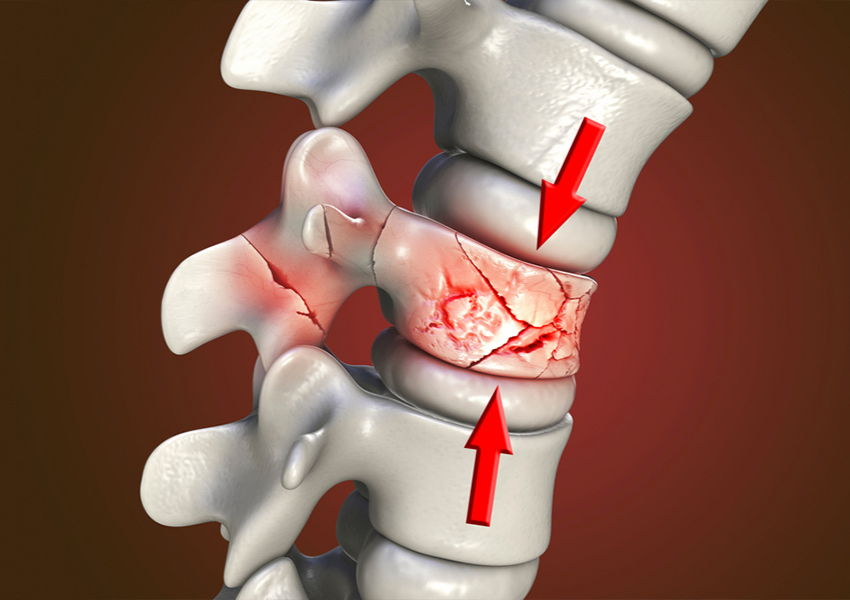 Omurga Kırığı Tedavisi