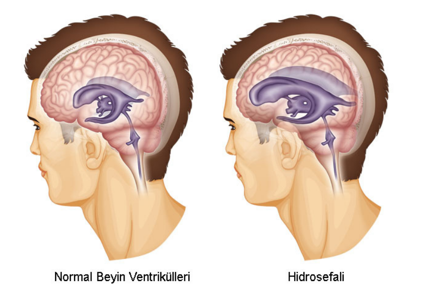 Hidrosefali Tedavisi